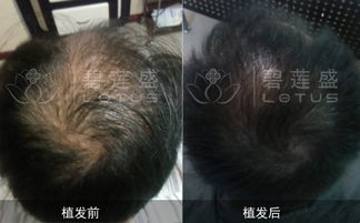 揭秘毛发种植技术：未来美容趋势还是炒作？