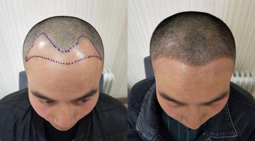 揭秘非技术毛发种植：安全可靠，效果显著？