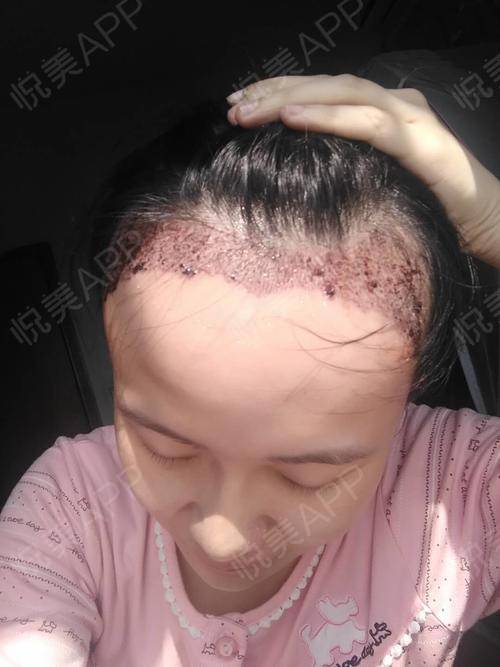揭秘额头种植头发技术：如何重塑你的完美额头？