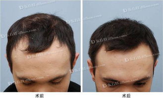 《额头种植头发：揭秘前沿技术，重塑自信人生》