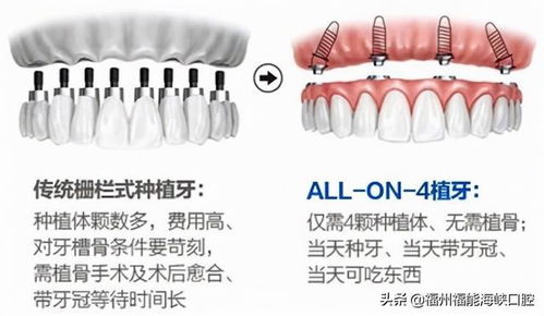 《种植牙技术：成熟之路上的革新与展望》