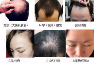 揭秘毛发种植技术：如何拥有浓密秀发？（附视频教程）