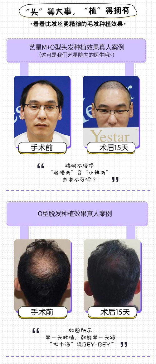 FUE毛发种植技术：揭秘无痕植发的秘密武器