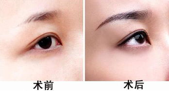 揭秘眉毛种植技术：重塑眉型，重拾自信之美