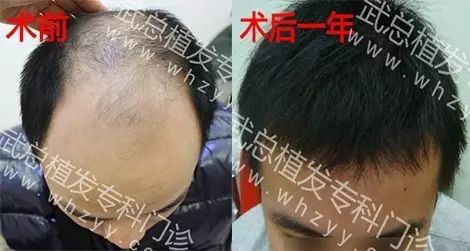 【自然新生：揭秘毛发种植技术前沿】