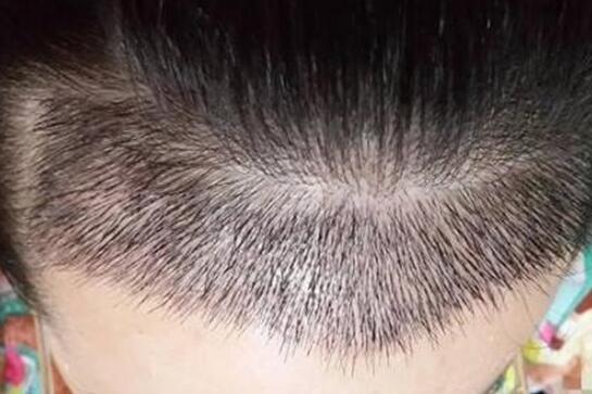 揭秘NTE毛发种植技术：如何重塑您的秀发风采？