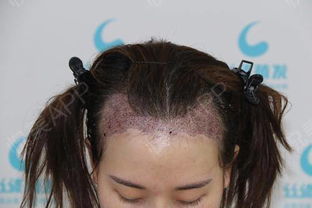 揭秘毛发种植技术：如何重拾浓密秀发？