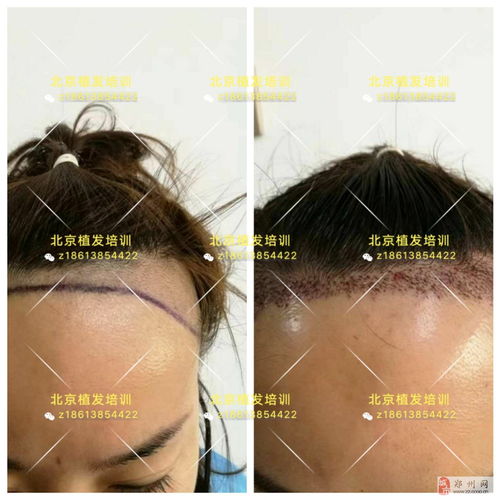 《揭秘头发种植：如何成为毛发移植领域的专家？》