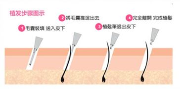 揭秘毛囊种植技术：重塑秀发，开启美丽新篇章？