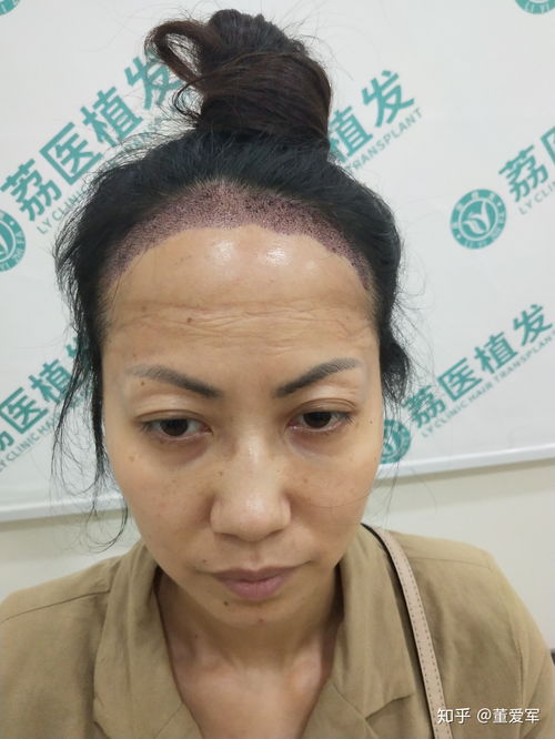 《揭秘毛发种植领域：如何找到最佳的进修之地？》