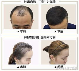毛发种植技术革新，你准备好了吗？