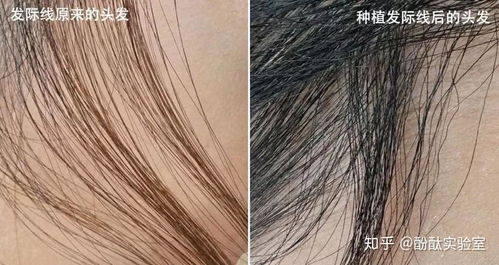 PHS毛发种植技术：揭秘植发界的革新力量