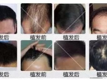 《植根未来：毛发种植技术的历史与展望》