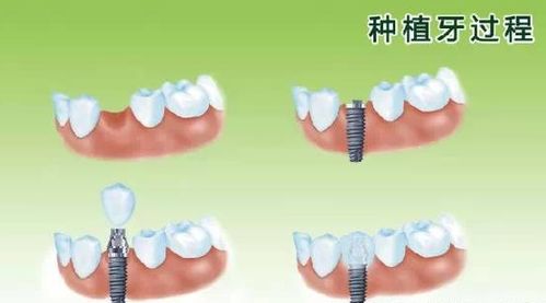 即刻种植牙技术：革新口腔修复的未来已来？