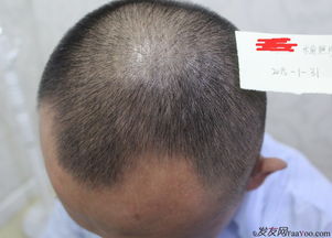 揭秘头发种植技术：如何重拾自信与风采？