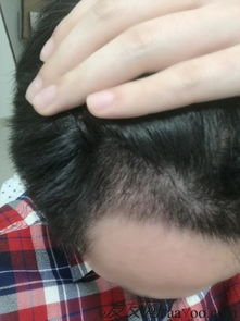 揭秘FUT毛发种植技术：重塑秀发，重拾自信