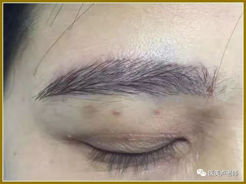 精细无痕毛发种植技术：重塑秀发，自然如初？