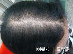 揭秘毛发种植技术大全：如何重拾自信，拥抱自然秀发？