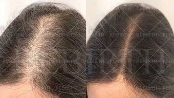 《毛发种植技术图解教程：如何让秀发重焕生机？揭秘行业前沿与实操步骤》