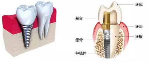 种植牙技术：引领口腔修复新潮流，您准备好了吗？