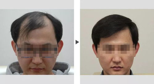 PDT毛发种植技术：重塑秀发，揭秘这项前沿美容革命