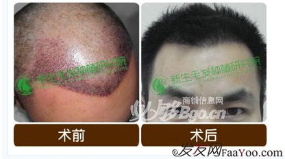 《揭秘新生毛发种植技术：如何重拾秀发自信？》