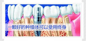 【前沿探秘】种植牙技术革新：揭秘口腔修复新篇章